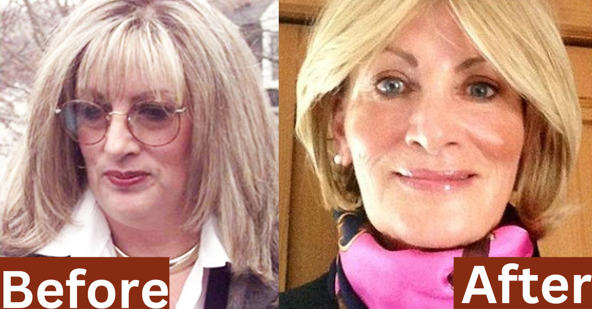 Did Linda Tripp Have Plastic Surgery? 
